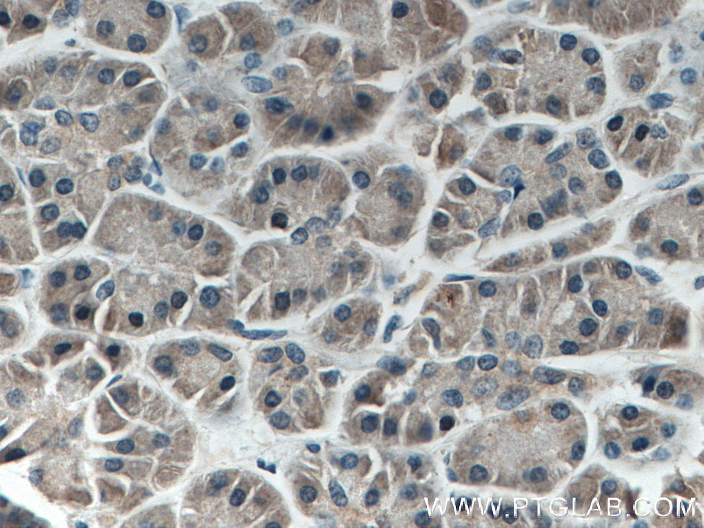 IHC staining of human pancreas cancer using 66720-1-Ig