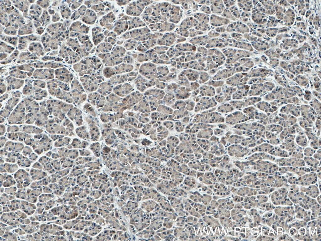 IHC staining of human pancreas cancer using 66720-1-Ig