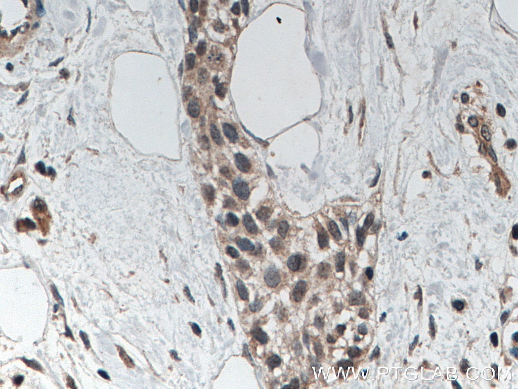 Immunohistochemistry (IHC) staining of human urothelial carcinoma tissue using AGO2 Monoclonal antibody (66720-1-Ig)
