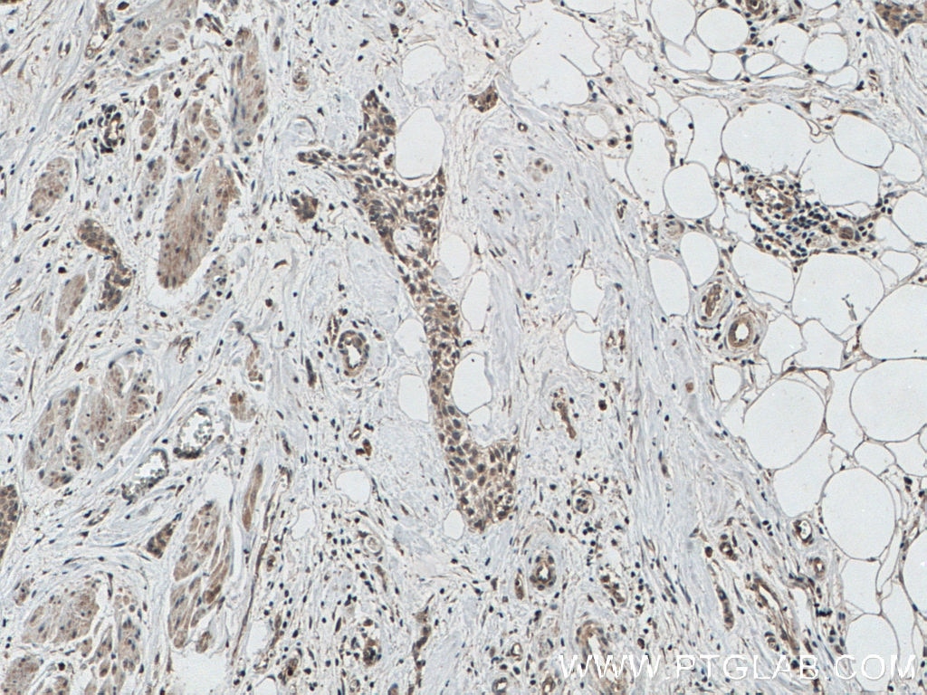IHC staining of human urothelial carcinoma using 66720-1-Ig