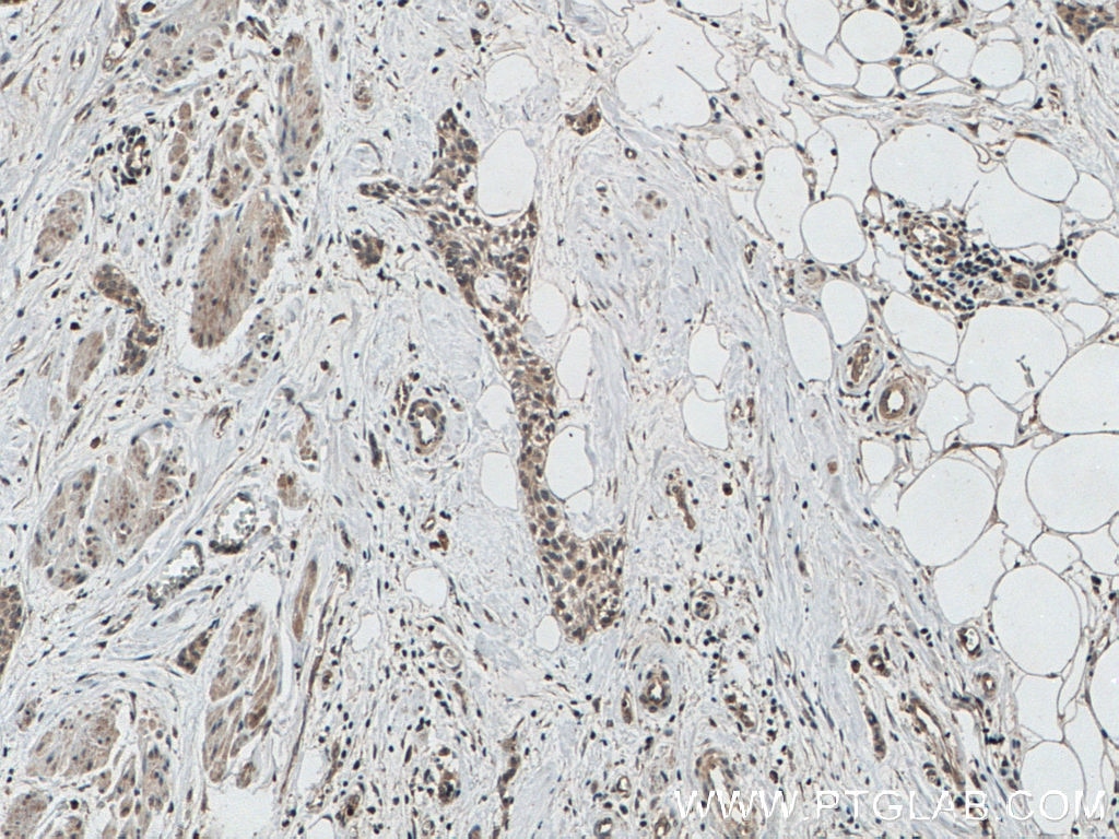 Immunohistochemistry (IHC) staining of human urothelial carcinoma tissue using AGO2 Monoclonal antibody (66720-1-Ig)