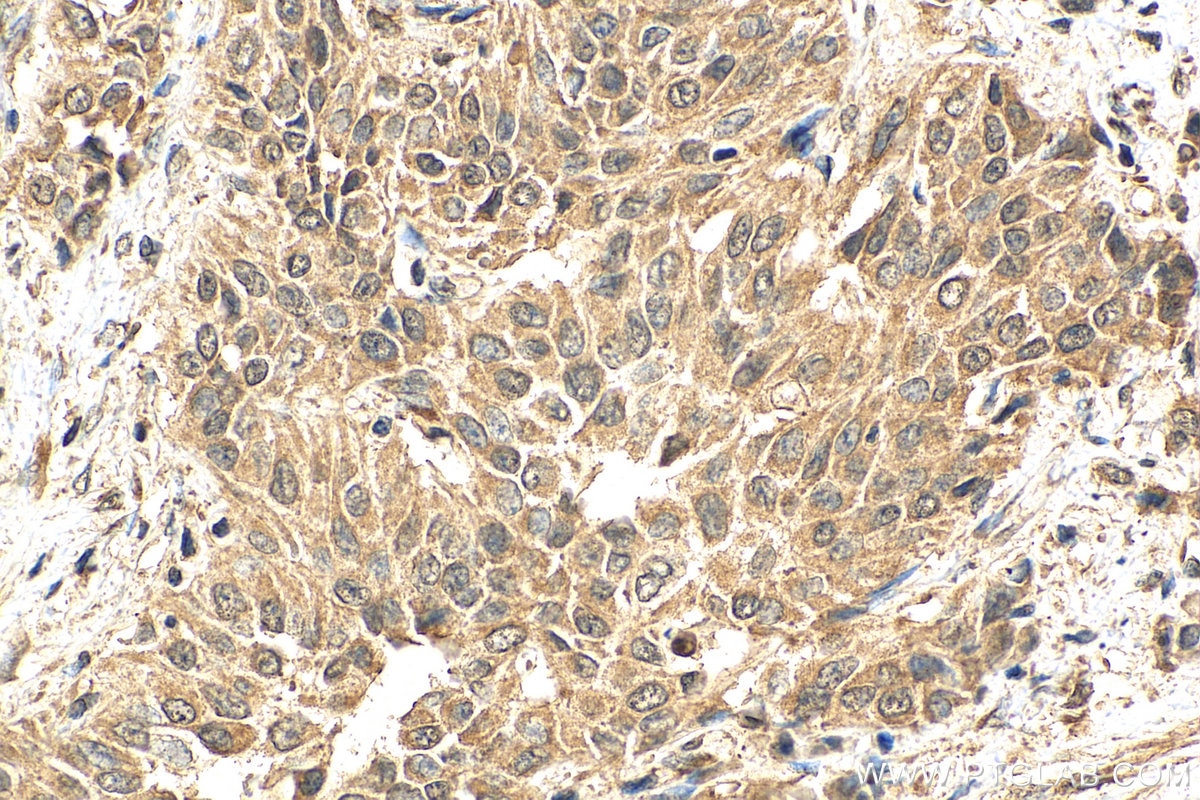 IHC staining of human urothelial carcinoma using 67934-1-Ig
