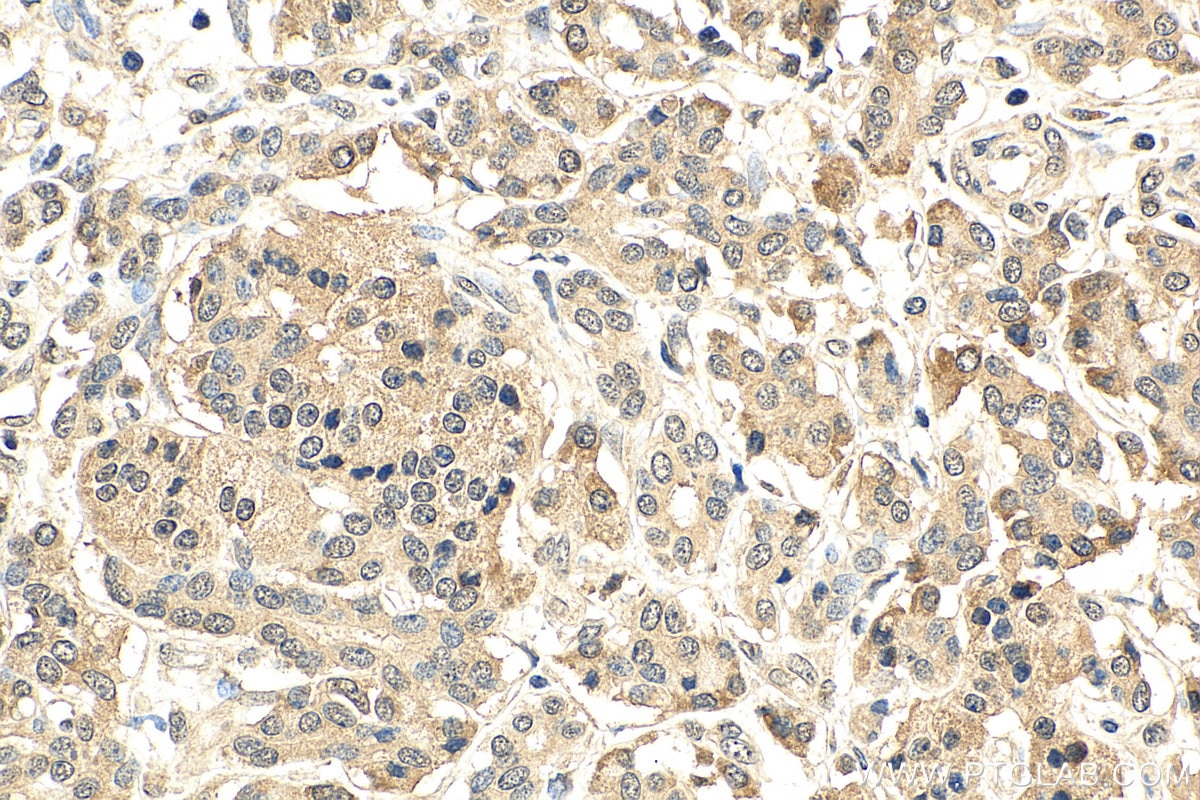 Immunohistochemistry (IHC) staining of human pancreas cancer tissue using AGO2 Monoclonal antibody (67934-1-Ig)