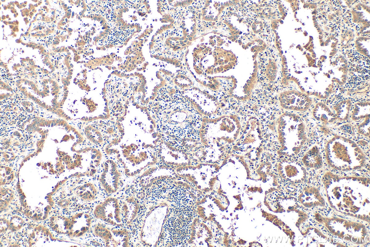 Immunohistochemistry (IHC) staining of human lung cancer tissue using AGPAT4 Polyclonal antibody (16562-1-AP)