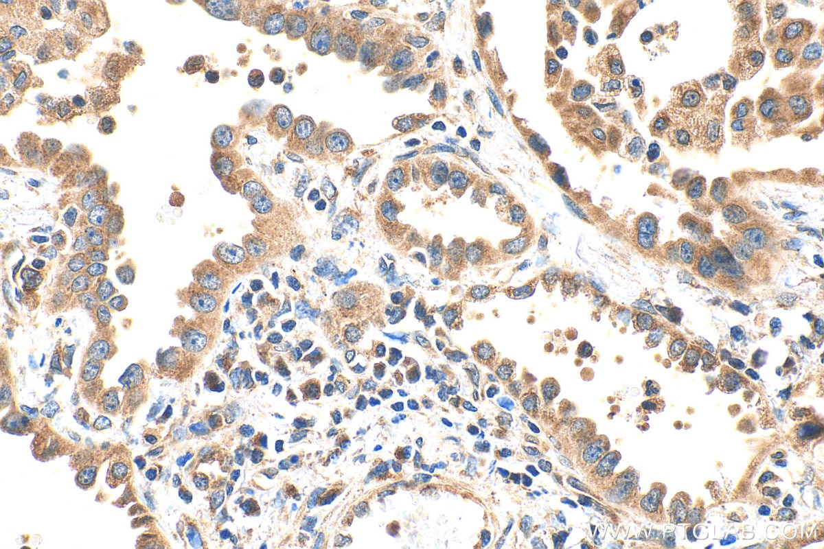 Immunohistochemistry (IHC) staining of human lung cancer tissue using AGPAT4 Polyclonal antibody (16562-1-AP)