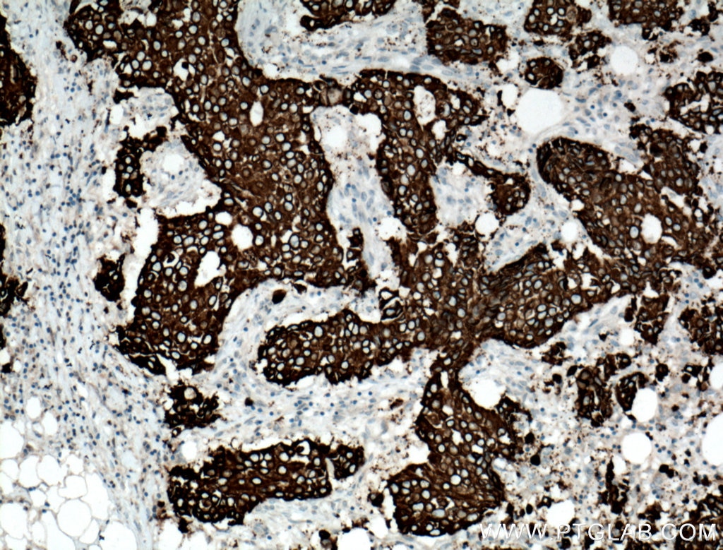 Immunohistochemistry (IHC) staining of human breast cancer tissue using AGR2 Polyclonal antibody (12275-1-AP)