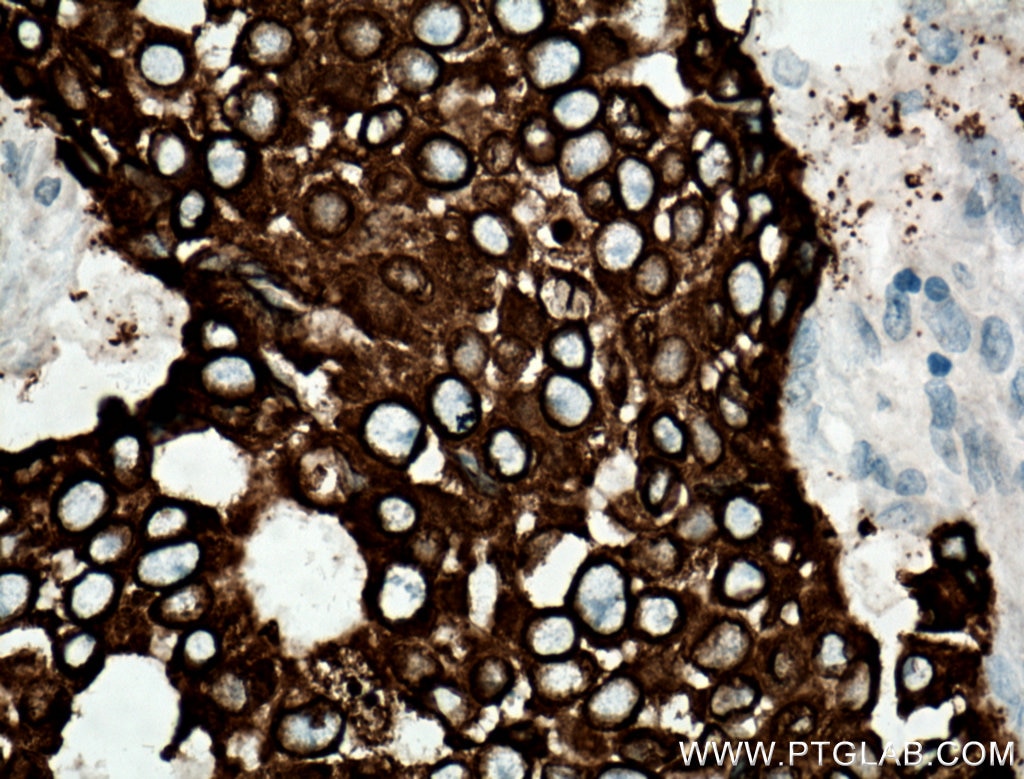 Immunohistochemistry (IHC) staining of human breast cancer tissue using AGR2 Polyclonal antibody (12275-1-AP)