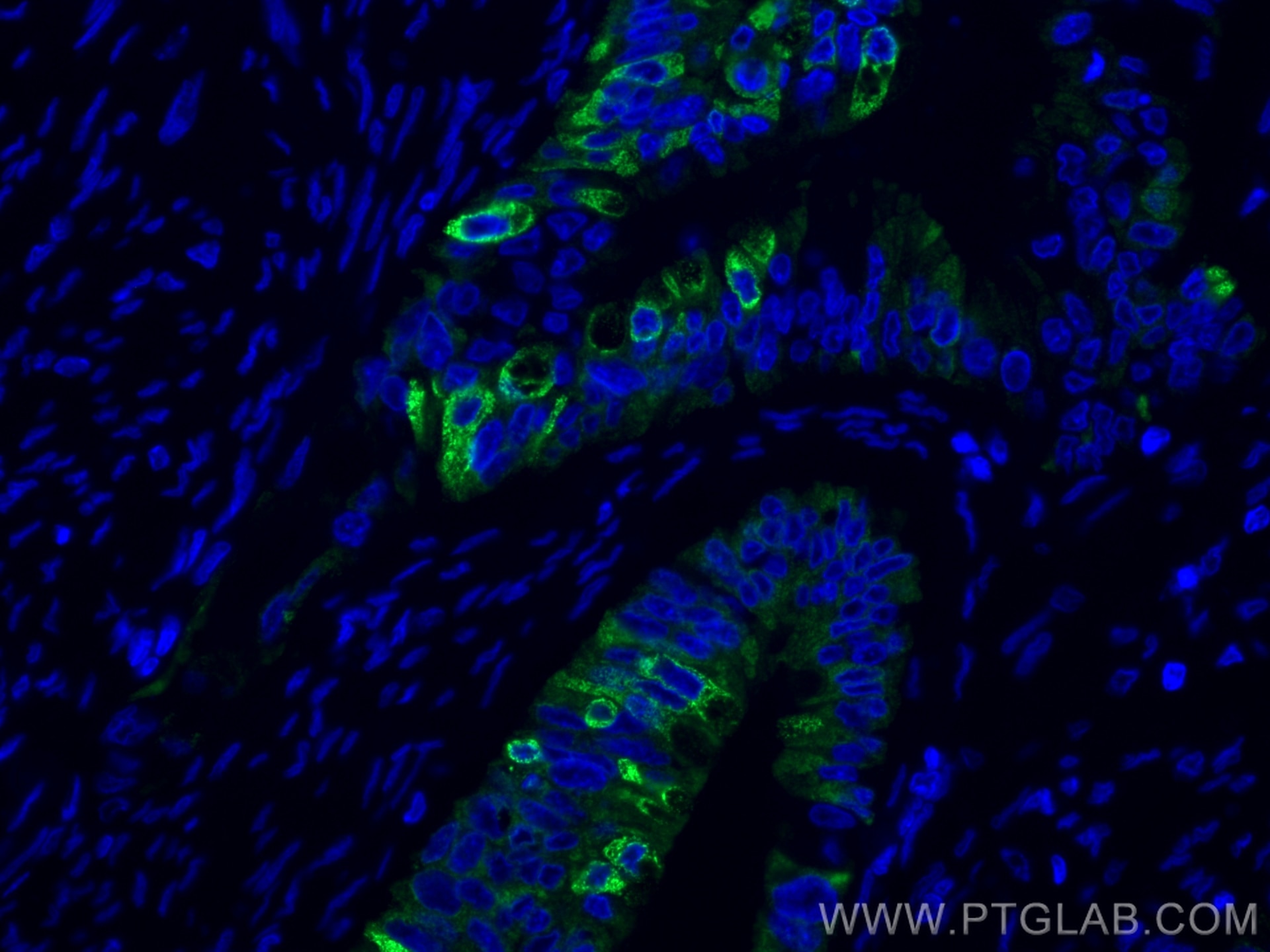 Immunofluorescence (IF) / fluorescent staining of human colon cancer tissue using AGR2 Monoclonal antibody (66768-1-Ig)