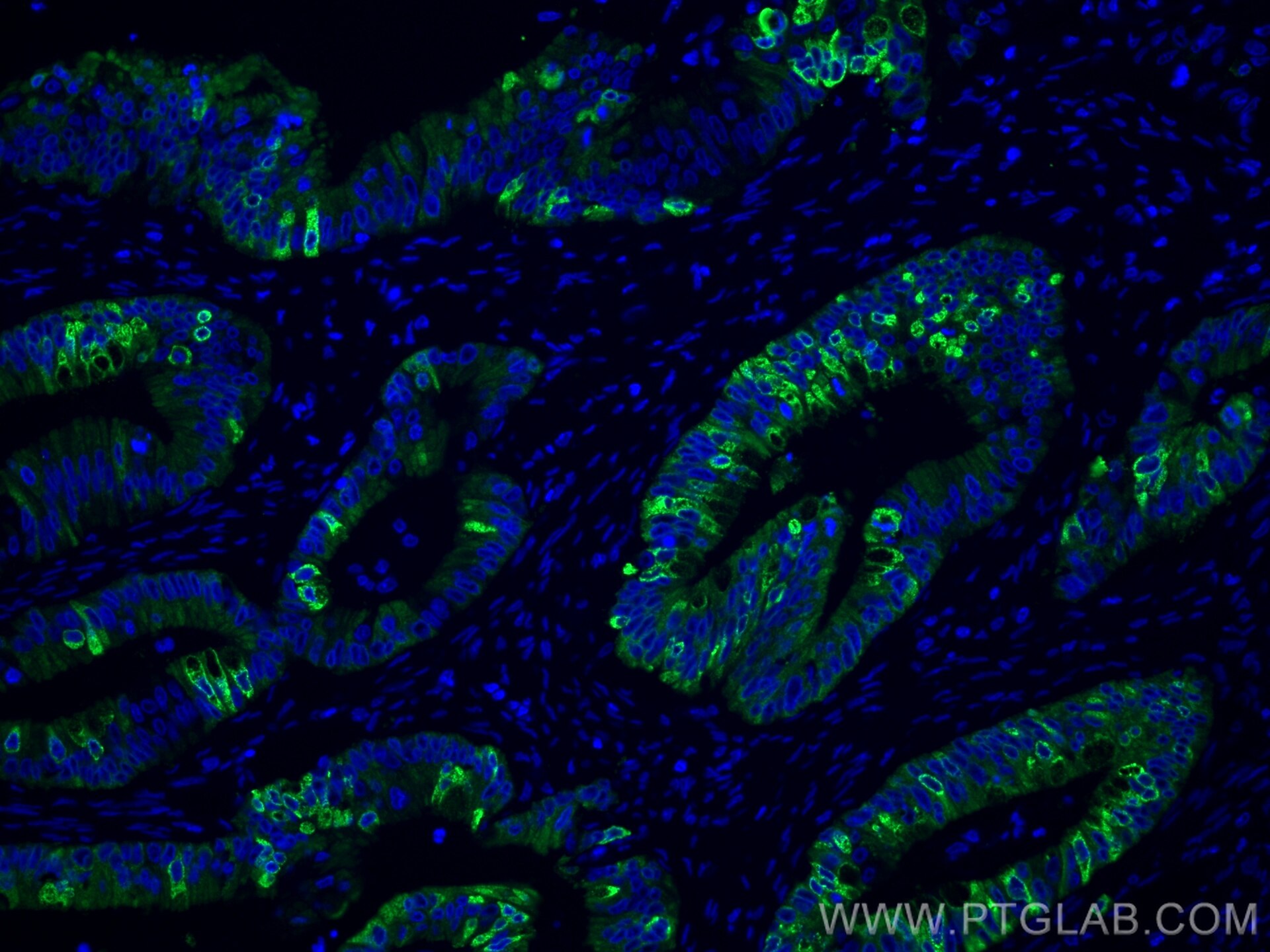 Immunofluorescence (IF) / fluorescent staining of human colon cancer tissue using AGR2 Monoclonal antibody (66768-1-Ig)