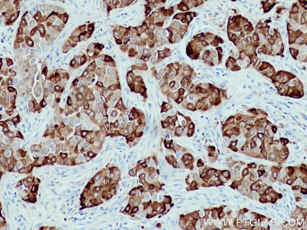 Immunohistochemistry (IHC) staining of human breast cancer tissue using AGR2 Monoclonal antibody (66768-1-Ig)