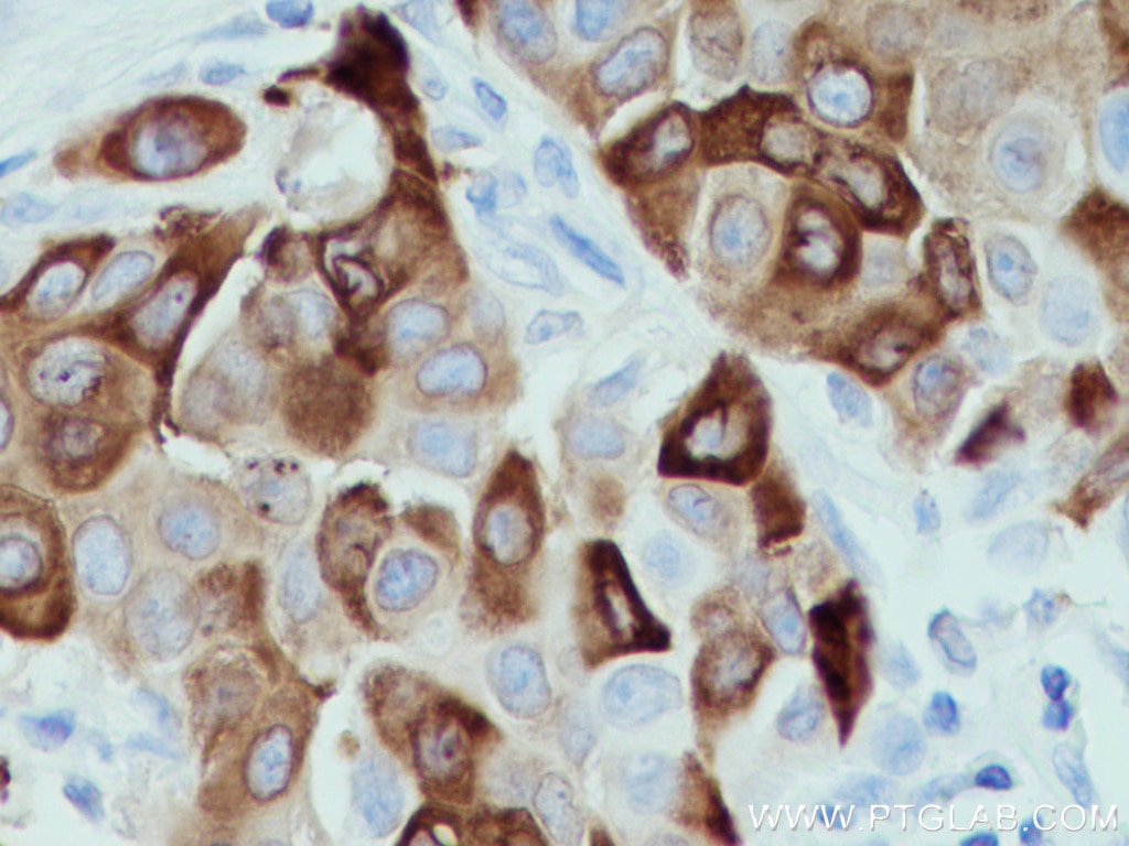Immunohistochemistry (IHC) staining of human breast cancer tissue using AGR2 Monoclonal antibody (66768-1-Ig)