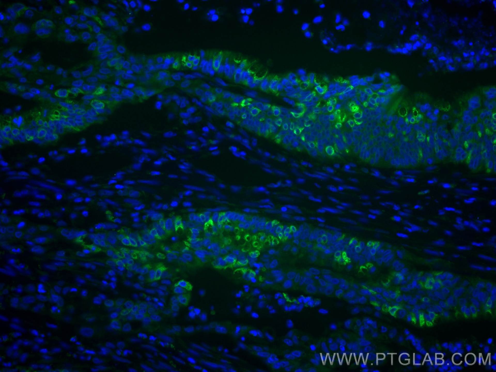 Immunofluorescence (IF) / fluorescent staining of human colon cancer tissue using CoraLite® Plus 488-conjugated AGR2 Monoclonal anti (CL488-66768)