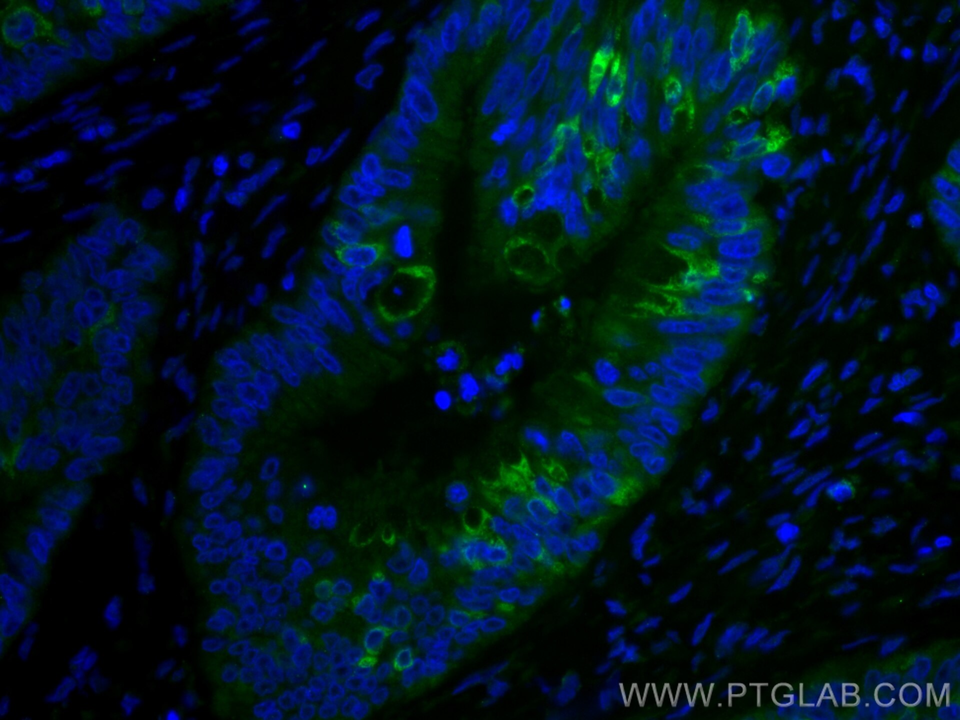 Immunofluorescence (IF) / fluorescent staining of human colon cancer tissue using CoraLite® Plus 488-conjugated AGR2 Monoclonal anti (CL488-66768)