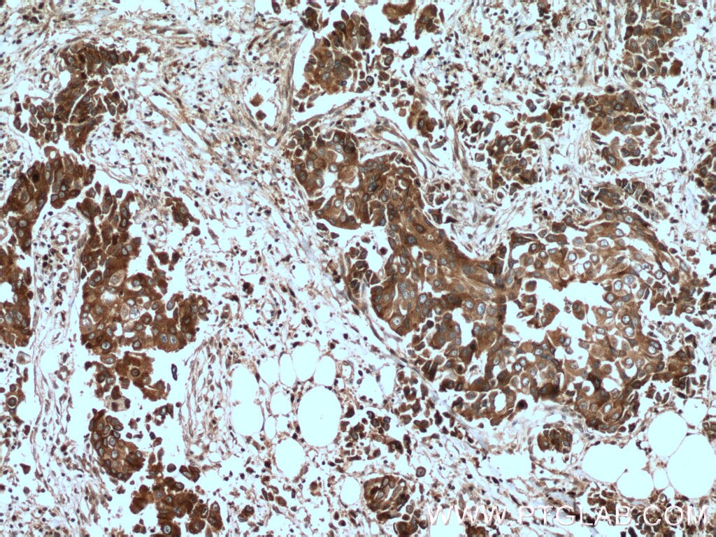 Immunohistochemistry (IHC) staining of human breast cancer tissue using AGR3 Polyclonal antibody (11967-1-AP)