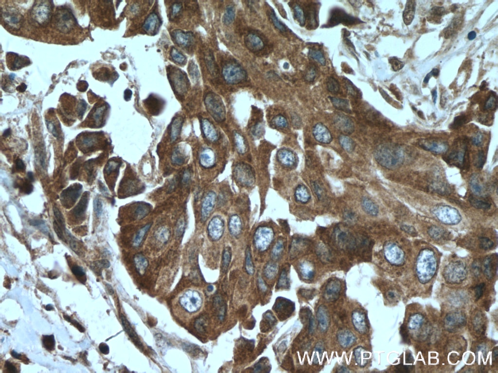 Immunohistochemistry (IHC) staining of human breast cancer tissue using AGR3 Polyclonal antibody (11967-1-AP)