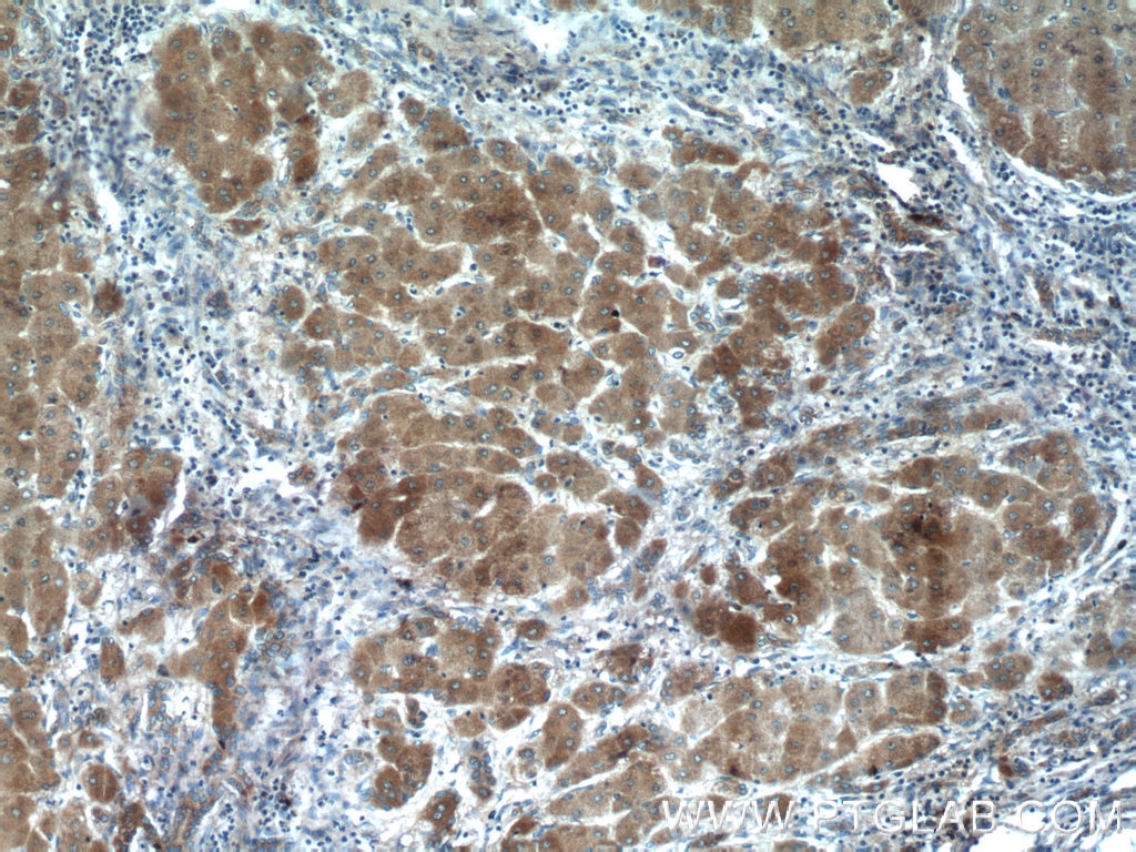 Immunohistochemistry (IHC) staining of human hepatocirrhosis tissue using Angiotensinogen Polyclonal antibody (23972-1-AP)