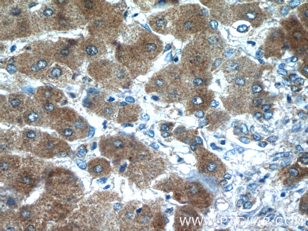 Immunohistochemistry (IHC) staining of human hepatocirrhosis tissue using Angiotensinogen Polyclonal antibody (23972-1-AP)
