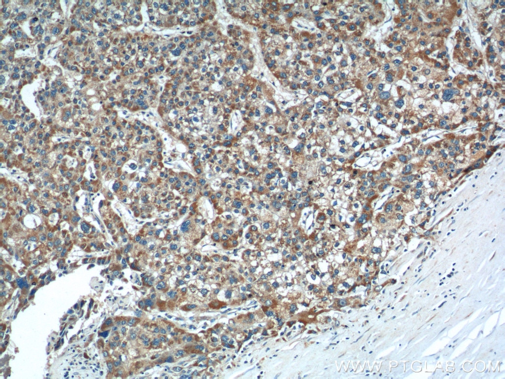 Immunohistochemistry (IHC) staining of human liver cancer tissue using AGTR1 Polyclonal antibody (25343-1-AP)