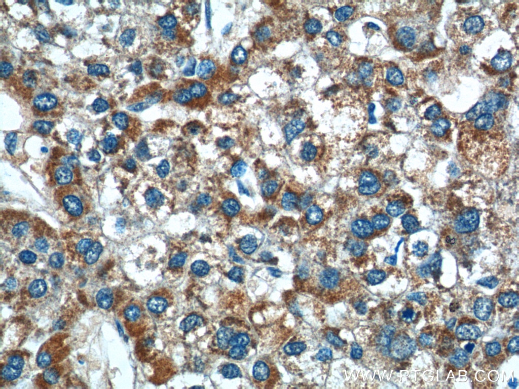 Immunohistochemistry (IHC) staining of human liver cancer tissue using AGTR1 Polyclonal antibody (25343-1-AP)