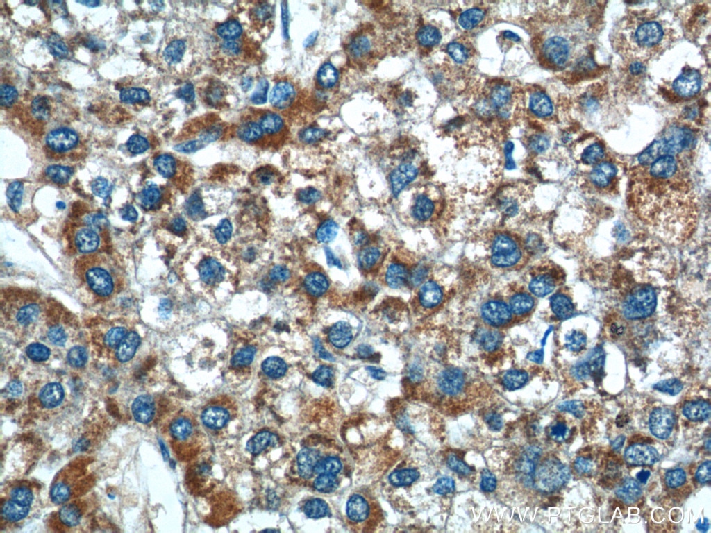 IHC staining of human liver cancer using 25343-1-AP