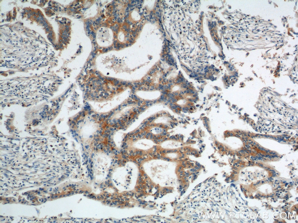 Immunohistochemistry (IHC) staining of human pancreas cancer tissue using AGTRAP Polyclonal antibody (11559-1-AP)