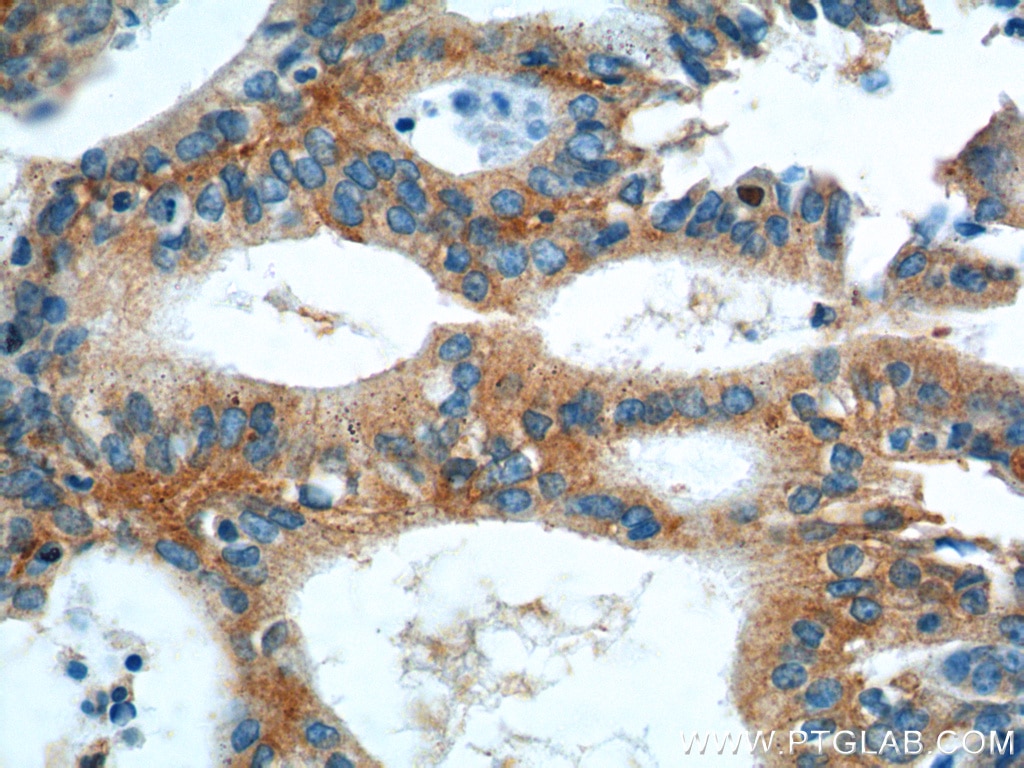 Immunohistochemistry (IHC) staining of human pancreas cancer tissue using AGTRAP Polyclonal antibody (11559-1-AP)