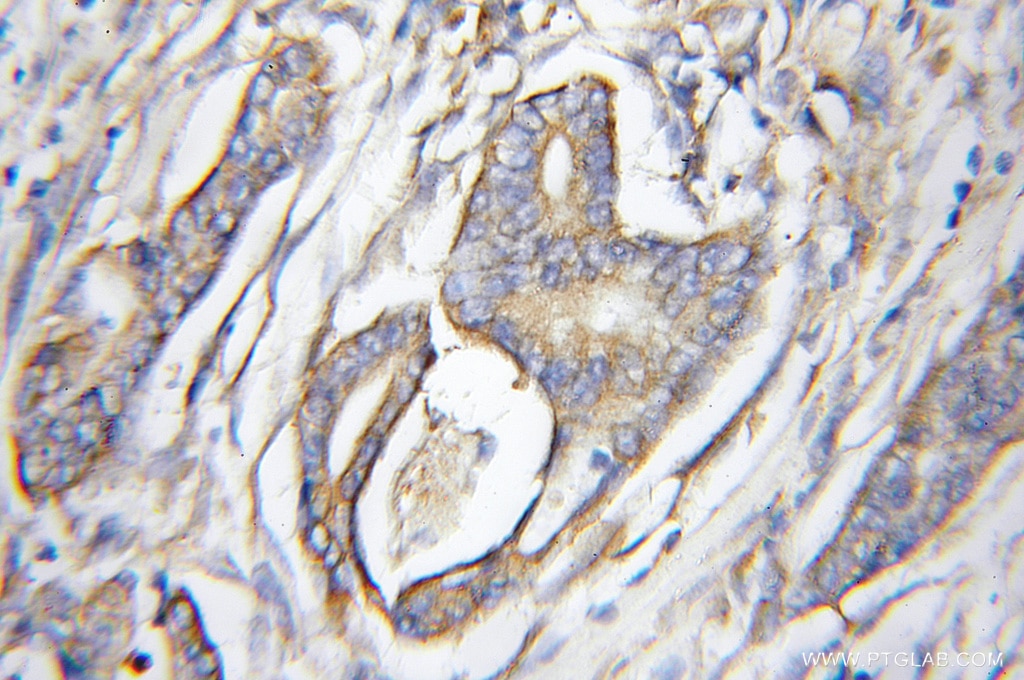IHC staining of human pancreas cancer using 11559-1-AP
