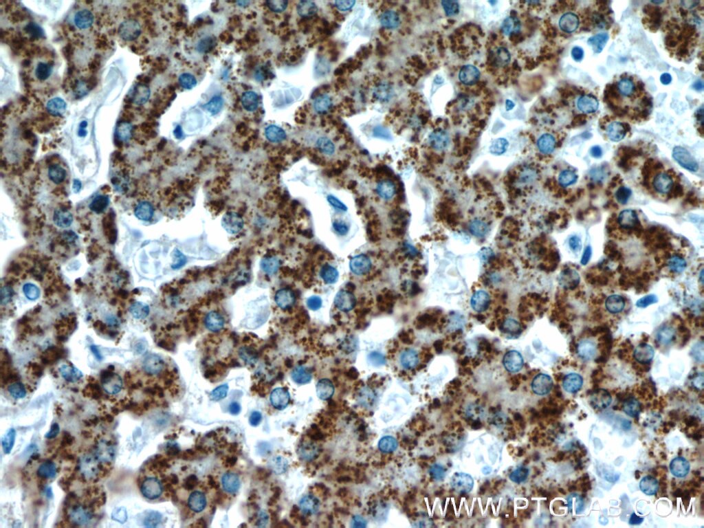 Immunohistochemistry (IHC) staining of human liver tissue using AGXT Polyclonal antibody (22394-1-AP)