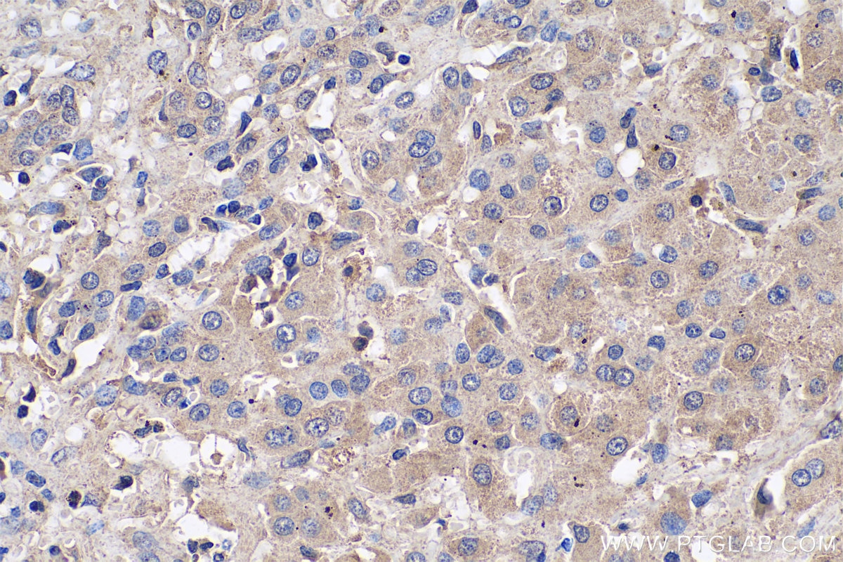 Immunohistochemistry (IHC) staining of human liver cancer tissue using AGXT Monoclonal antibody (67402-1-Ig)