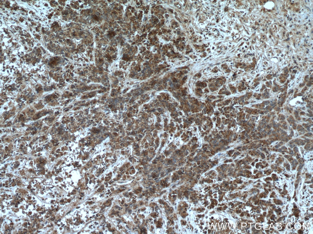Immunohistochemistry (IHC) staining of human prostate cancer tissue using AGXT2L2 Polyclonal antibody (16449-1-AP)