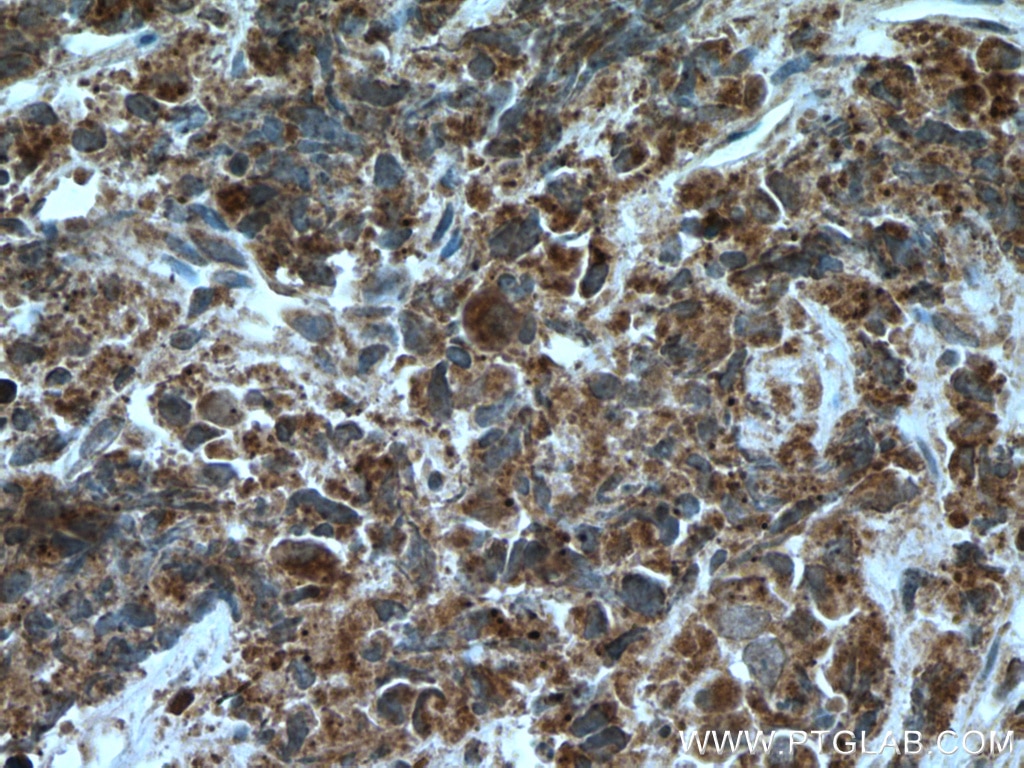 Immunohistochemistry (IHC) staining of human prostate cancer tissue using AGXT2L2 Polyclonal antibody (16449-1-AP)