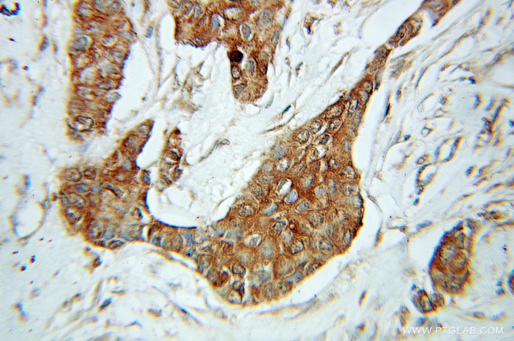 IHC staining of human breast cancer using 10757-2-AP