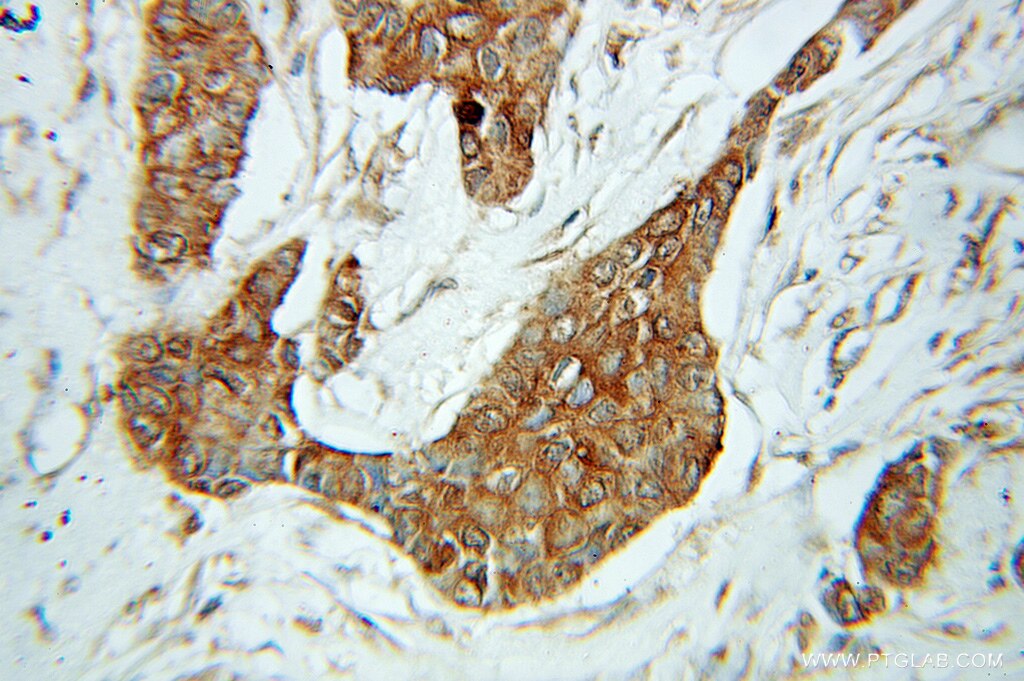 Immunohistochemistry (IHC) staining of human breast cancer tissue using AHCY Polyclonal antibody (10757-2-AP)