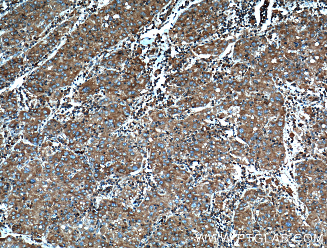 Immunohistochemistry (IHC) staining of human liver cancer tissue using AHCYL1 Polyclonal antibody (10658-3-AP)