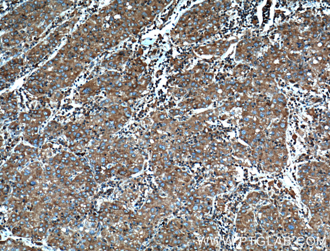 IHC staining of human liver cancer using 10658-3-AP