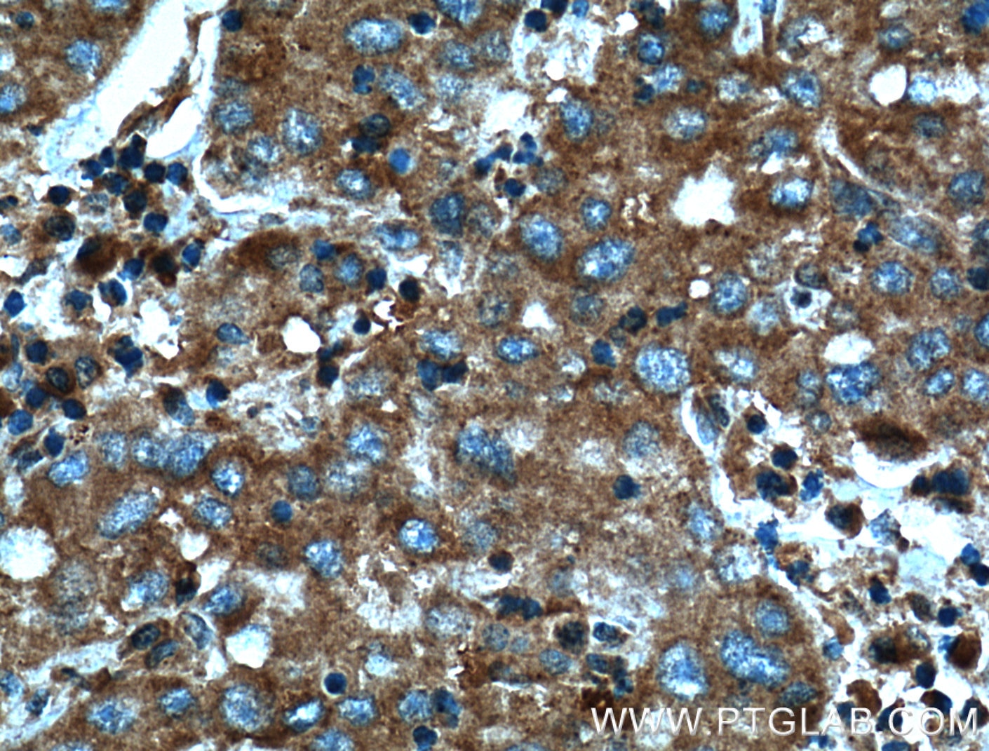 Immunohistochemistry (IHC) staining of human liver cancer tissue using AHCYL1 Polyclonal antibody (10658-3-AP)