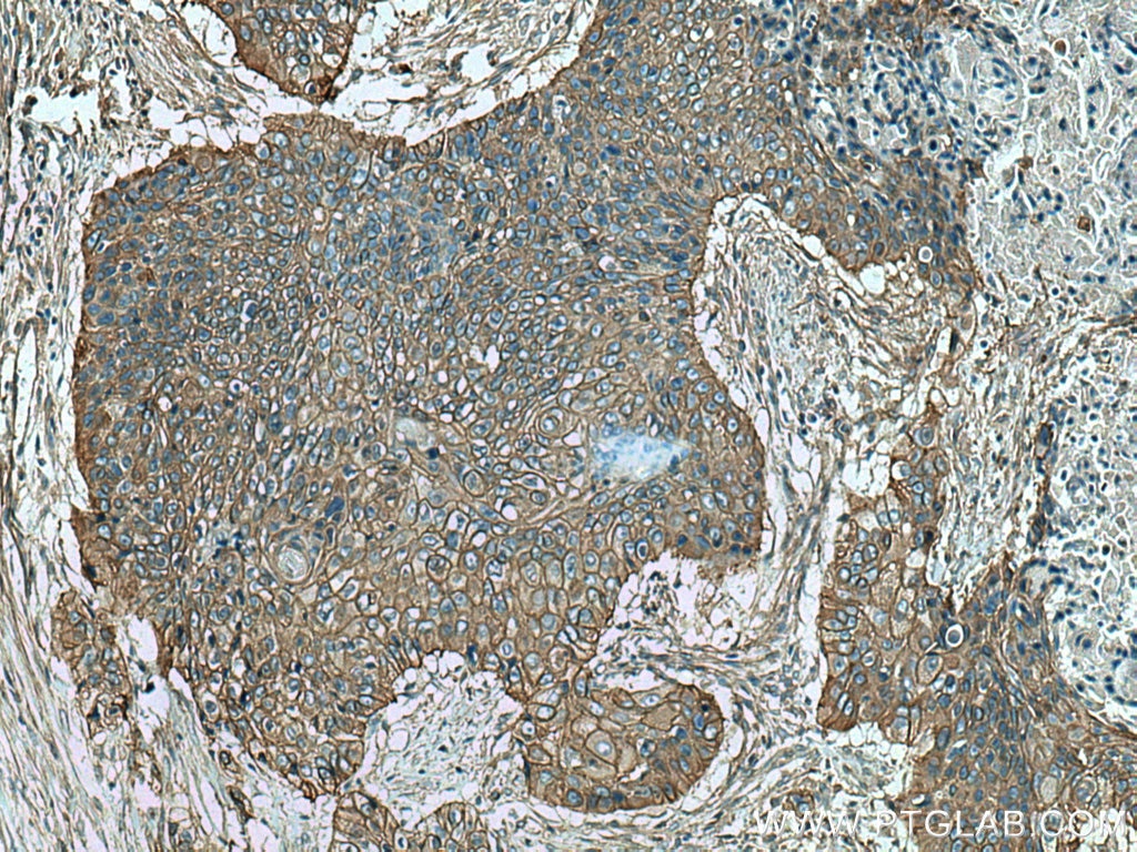 Immunohistochemistry (IHC) staining of human oesophagus cancer tissue using AHNAK Polyclonal antibody (16637-1-AP)