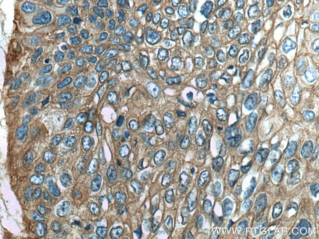 Immunohistochemistry (IHC) staining of human oesophagus cancer tissue using AHNAK Polyclonal antibody (16637-1-AP)