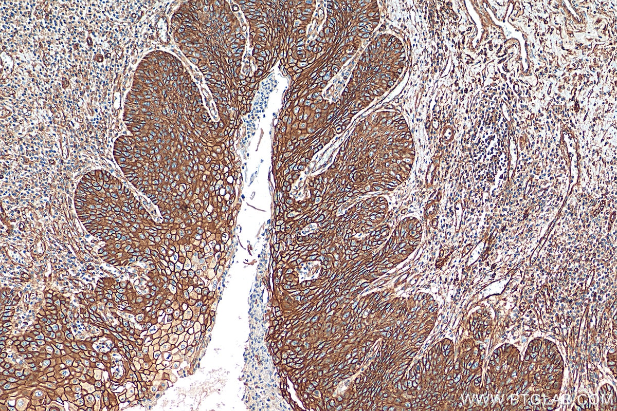 Immunohistochemistry (IHC) staining of human oesophagus cancer tissue using AHNAK Polyclonal antibody (16637-1-AP)