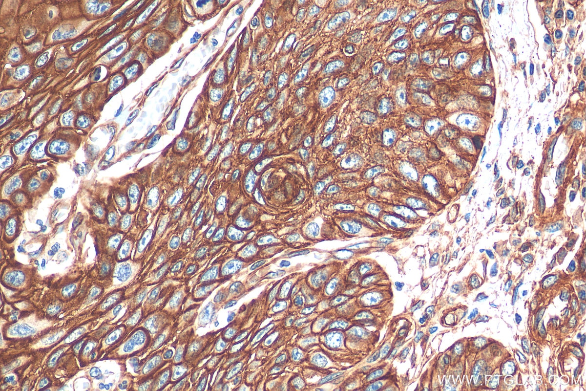 IHC staining of human oesophagus cancer using 16637-1-AP