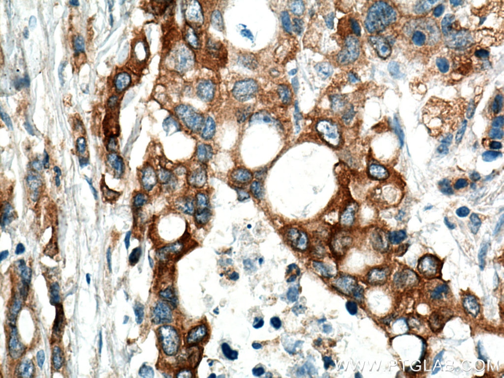 Immunohistochemistry (IHC) staining of human pancreas cancer tissue using AHNAK2 Polyclonal antibody (17682-1-AP)