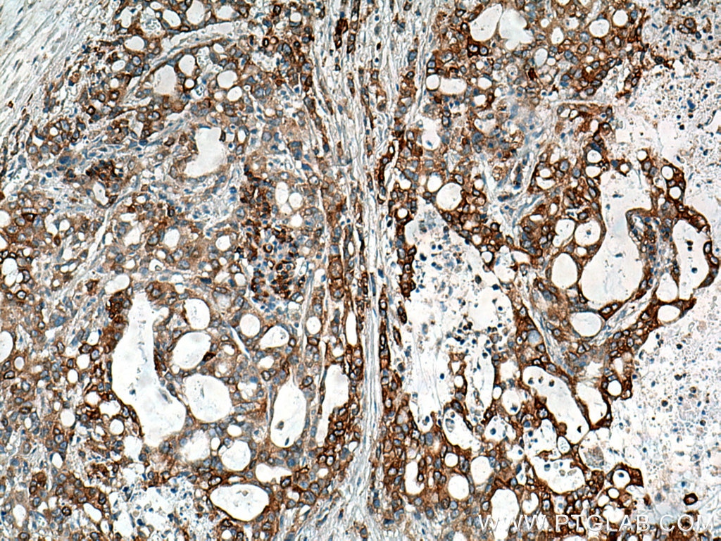 Immunohistochemistry (IHC) staining of human pancreas cancer tissue using AHNAK2 Polyclonal antibody (17682-1-AP)