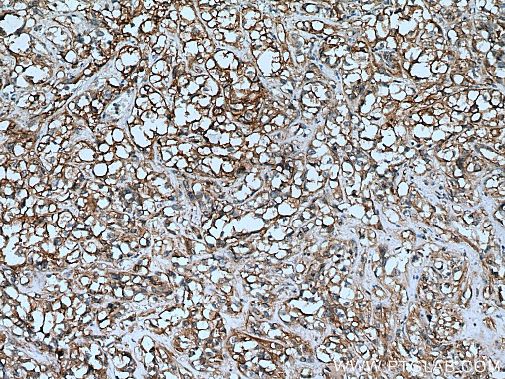 Immunohistochemistry (IHC) staining of human renal cell carcinoma tissue using AHNAK2 Polyclonal antibody (17682-1-AP)