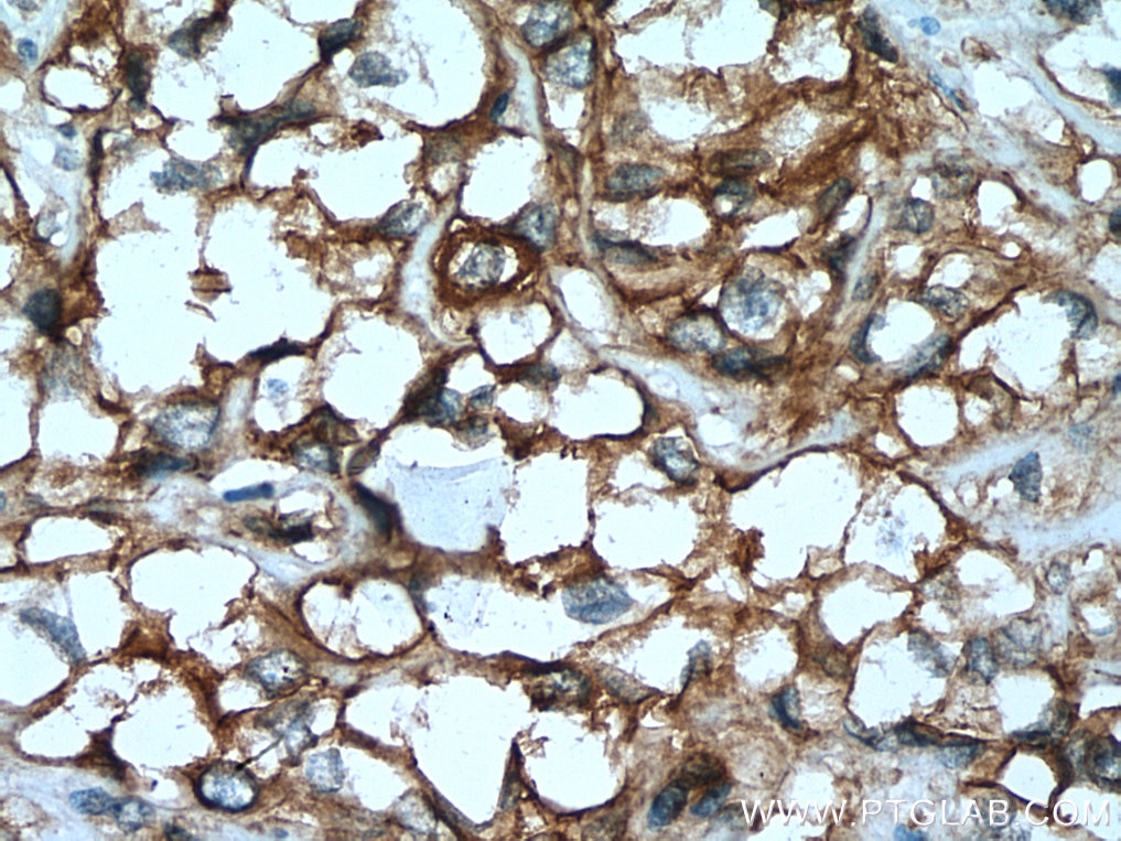 Immunohistochemistry (IHC) staining of human renal cell carcinoma tissue using AHNAK2 Polyclonal antibody (17682-1-AP)