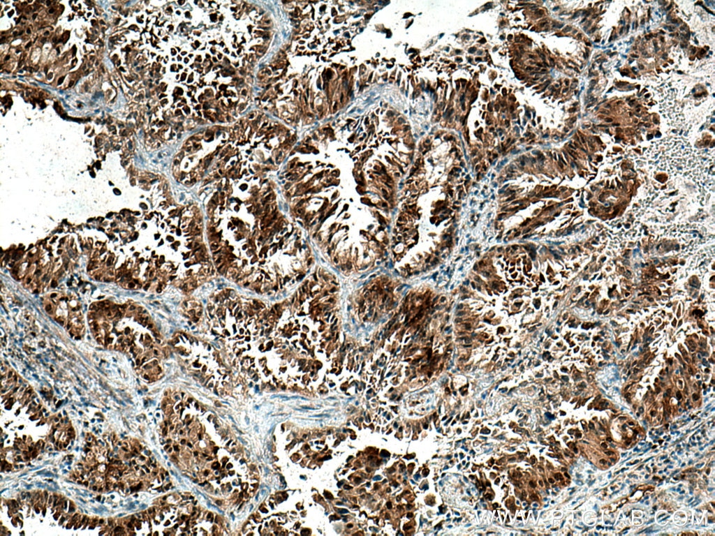 Immunohistochemistry (IHC) staining of human lung cancer tissue using AHR Polyclonal antibody (17840-1-AP)