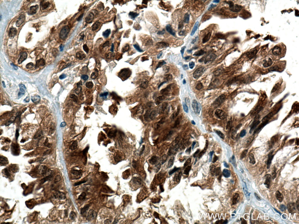 Immunohistochemistry (IHC) staining of human lung cancer tissue using AHR Polyclonal antibody (17840-1-AP)