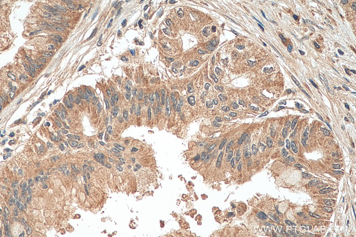 Immunohistochemistry (IHC) staining of human pancreas cancer tissue using AHR Polyclonal antibody (28727-1-AP)