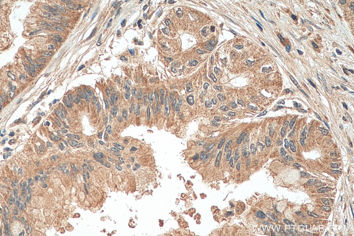 IHC staining of human pancreas cancer using 28727-1-AP