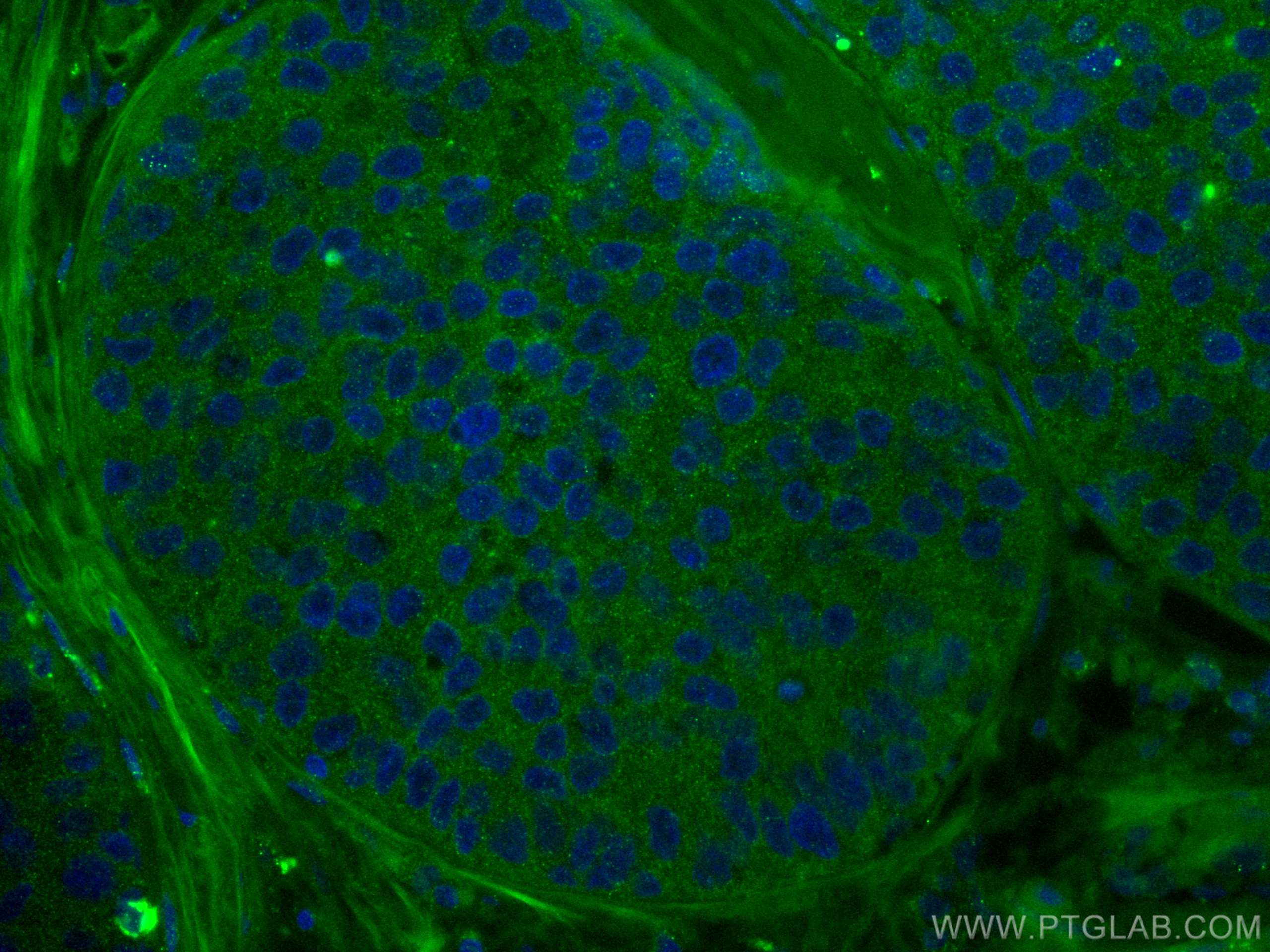 Immunofluorescence (IF) / fluorescent staining of human breast cancer tissue using AHR Monoclonal antibody (67785-1-Ig)