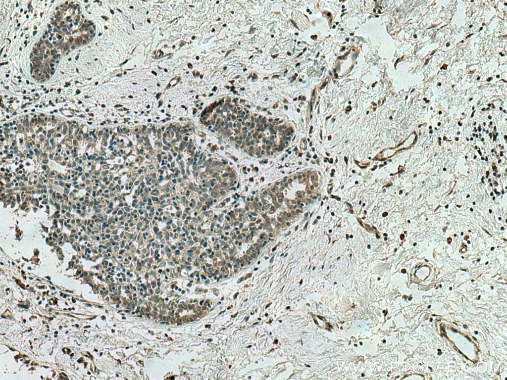 Immunohistochemistry (IHC) staining of human breast cancer tissue using AHR Monoclonal antibody (67785-1-Ig)